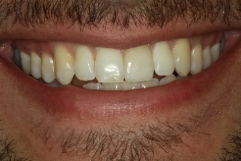 After Veneers